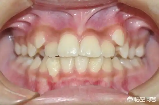 为什么人的虎牙最容易长错位?
