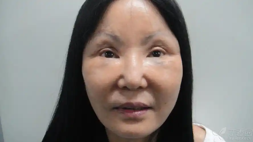 【讨论】重睑术后上睑凹陷填充 [病例帖]