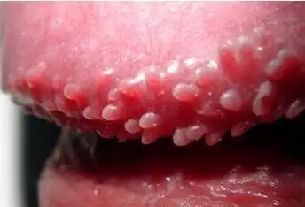 龟头冠状沟珍珠丘疹多见于 中青年男性,常出现1-3mm大小的丘疹,位于