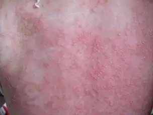 过敏性皮炎图片