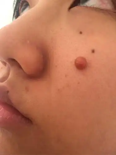 长了一个像肉瘤一样的东西,三个多月到现在基本已停止变大开始是肤色