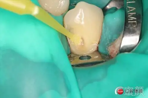 分享一组双尖牙根面龋补牙案例