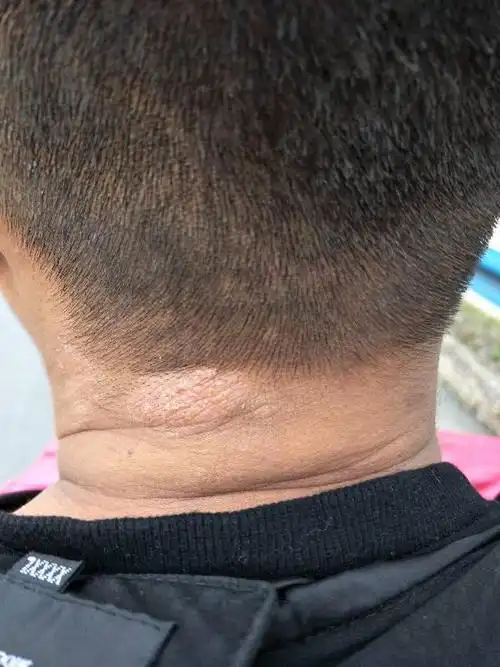 脖子上长了一块像癣一样的东西,之前胳膊上也有,好几个月了到底怎么