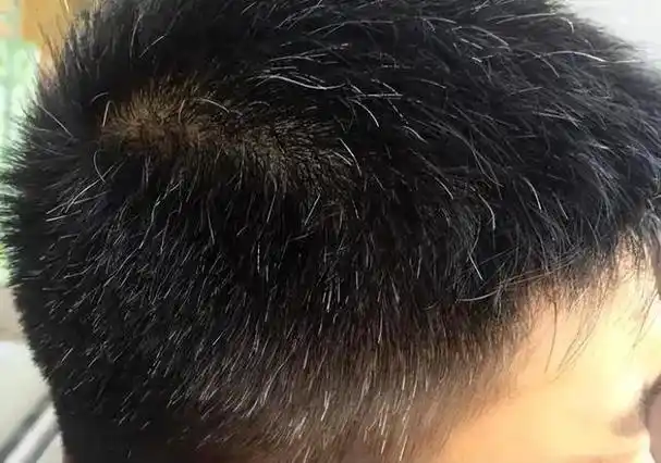 先来说说青少年的白发.从中医角度来讲:多与肝郁化火有关.