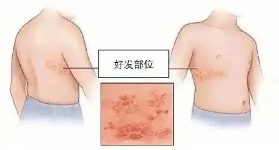 带状疱疹俗称"蛇缠腰"可以打疫苗预防