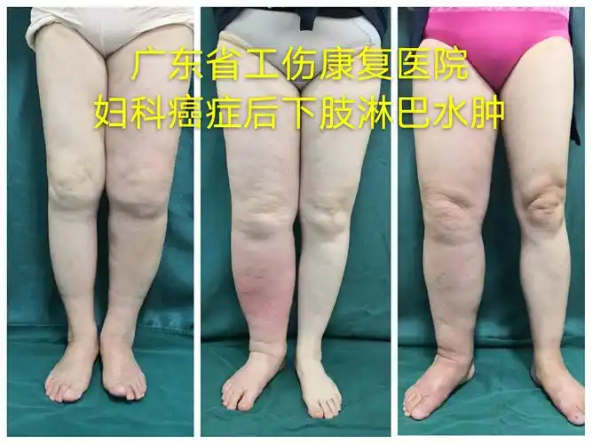 妇科癌症术后下肢淋巴水肿