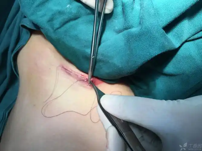 【讨论】秀一秀假体隆胸腋下入路切口缝合方法