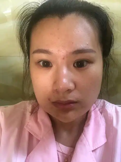 面颊脂肪填充过量失败修复分享