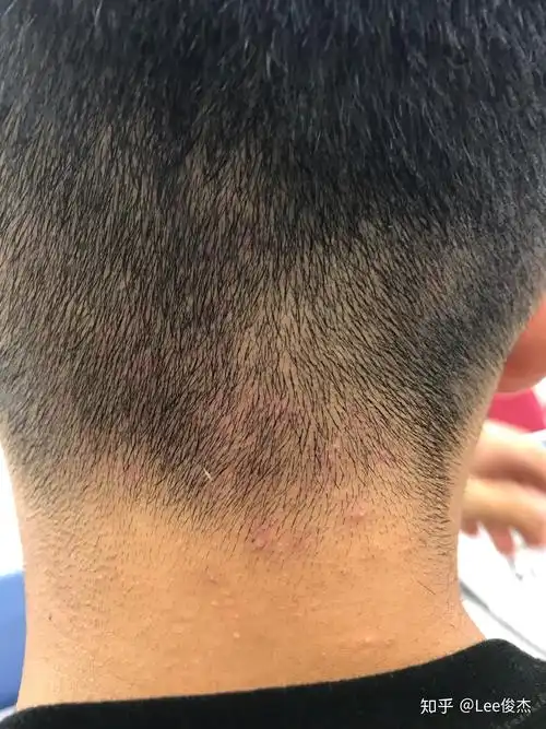 头部毛囊炎三年了反复多次