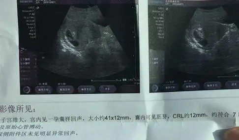 b超单上藏着的3种"信息",可能是孕妈想知道的"秘密"不妨一看_宝宝