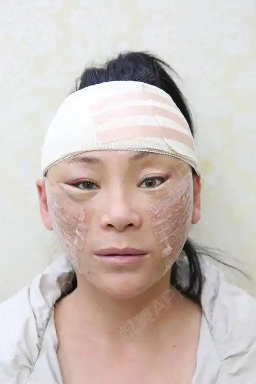 小切口手术提升术后3天_埋线提升术后3天_拉皮手术提升术后3天_紧致