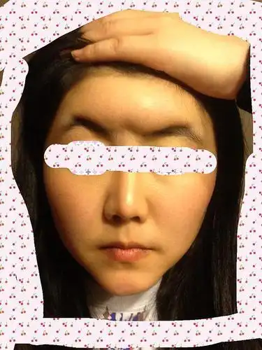 自体脂肪填充手术失败. 有专业人士请教吗 ?