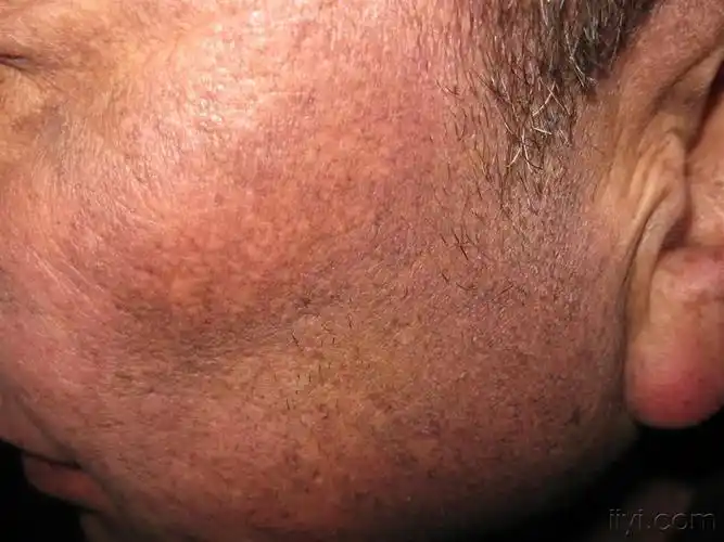 皮肤及性传播疾病讨论版 - 爱爱医医学论坛