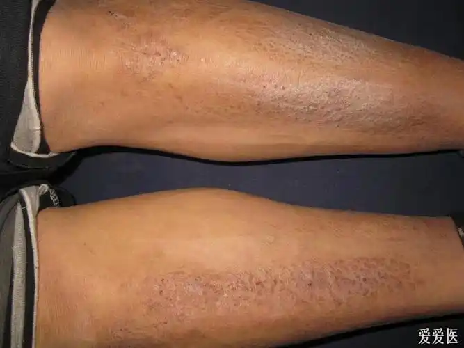 典型病例-------------------------双腿胫前皮肤淀粉样变