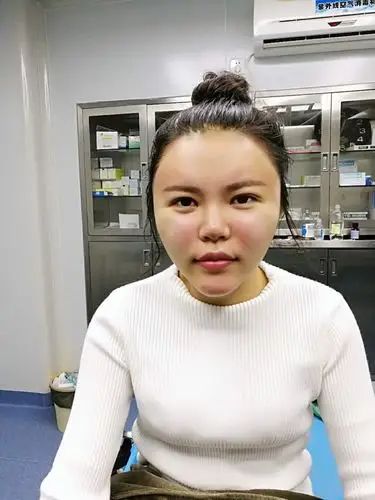 给你们看一下我术后即刻的照片,不得不说脂肪填充脸简_圈子-新氧美容