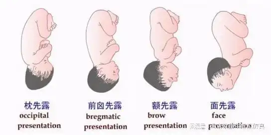 虚拟仿真软件带你了解持续性枕横位分娩机制|胎位|胎头|胎儿_网易订阅