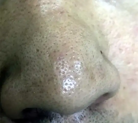 油性皮肤有黑头毛孔粗大怎么办?用什么能去除黑头和收缩毛孔?