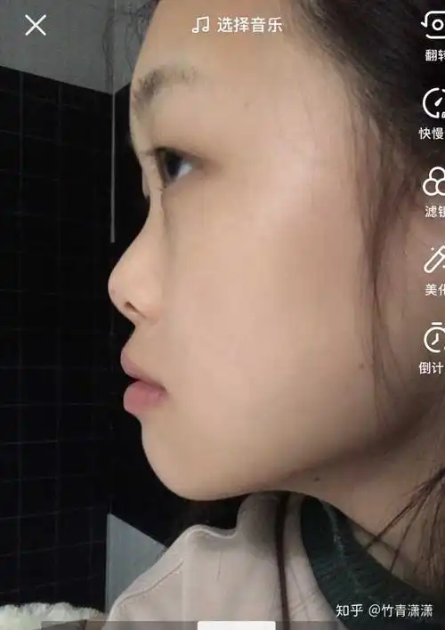 的感觉 就是侧脸拍会看到另一边眼睛鼓起的感觉 我者压根就是鼻梁凹陷