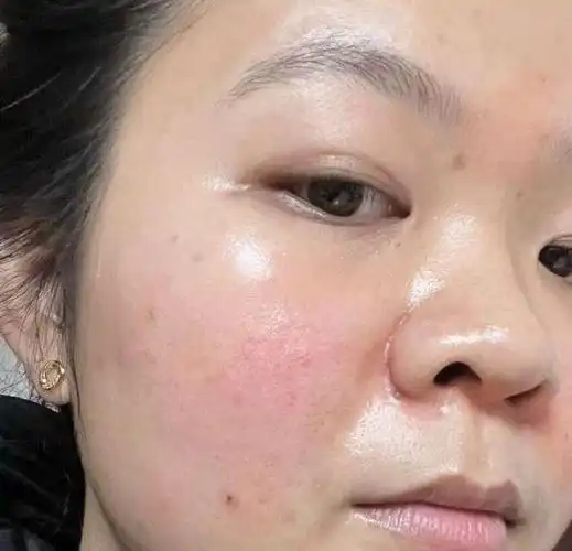 急急急脸上敏感泛红干燥脱皮咋整啊有什么能一次性修复好皮肤