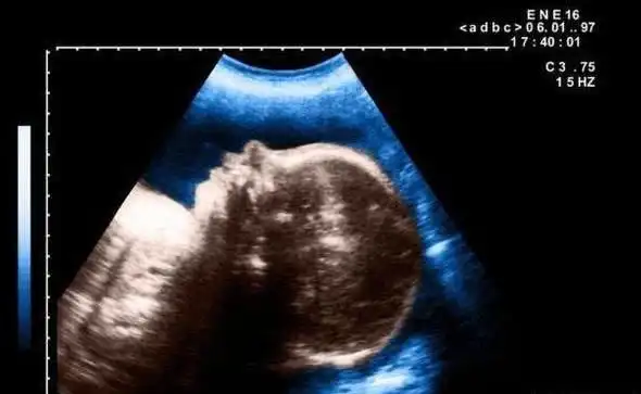 怪胎独眼婴儿五官严重变形医生无法判断病因家人也感到无奈