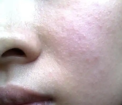 【化妆品皮肤过敏】 脸部皮肤使用化妆品过敏如何治_杨文国 - 365整形