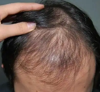 头发很痒,还总能抠出"白泥"?医生:"元凶"已找到,太多人却容易忽视