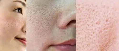 毛孔粗大,皮肤出油应该怎么办?千金御坊修复解您烦忧!