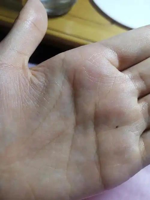 手掌后天长了一颗痣,有什么说法吗?是左手