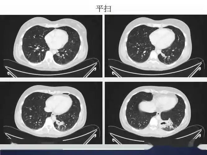 本是同根生相煎何太急肺隔离症一例