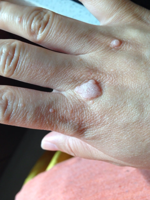 谁知道瘊子怎么去掉?