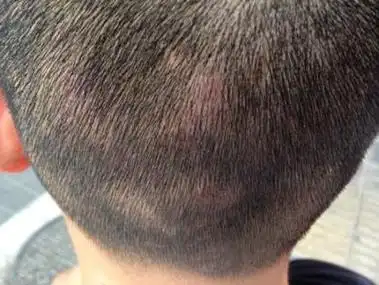 吃哪些水果可以缓解头皮痒