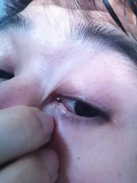 眼睛里内侧长了个黑东西是什么?