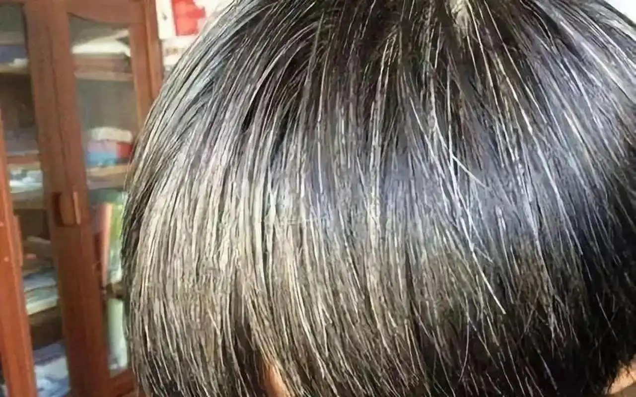 短短1个月的时间长了满头白头发,男孩父母看着儿子年纪轻轻满头白发