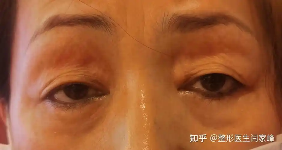 被误诊为"上睑下垂"的"重症肌无力"