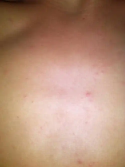 我也有, 追答: 去药店看看,我用皮炎平 涂大概一个星期左右才好 注意