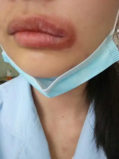嘴角长了这个东西,去医院说是疱疹.