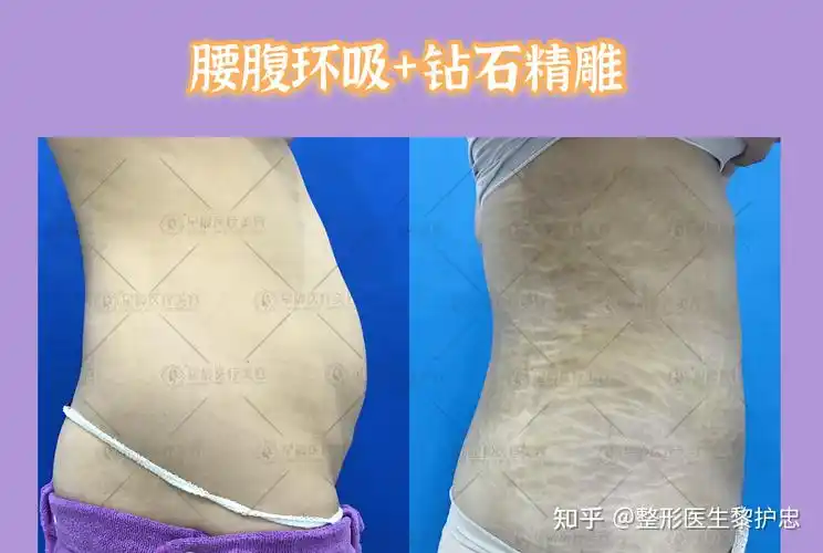 腰腹环吸联合钻石精雕案例分享 - 知乎