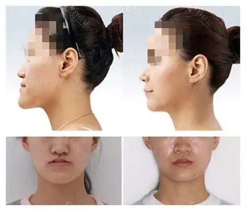 正颌手术前后对比照片