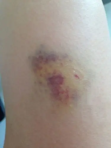 蔡卓妍过年玩得兴奋不慎受伤晒大腿淤血照片