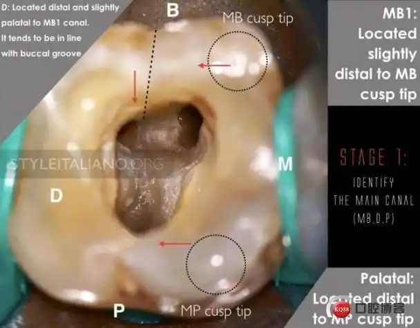上颌mb2真的存在吗676767