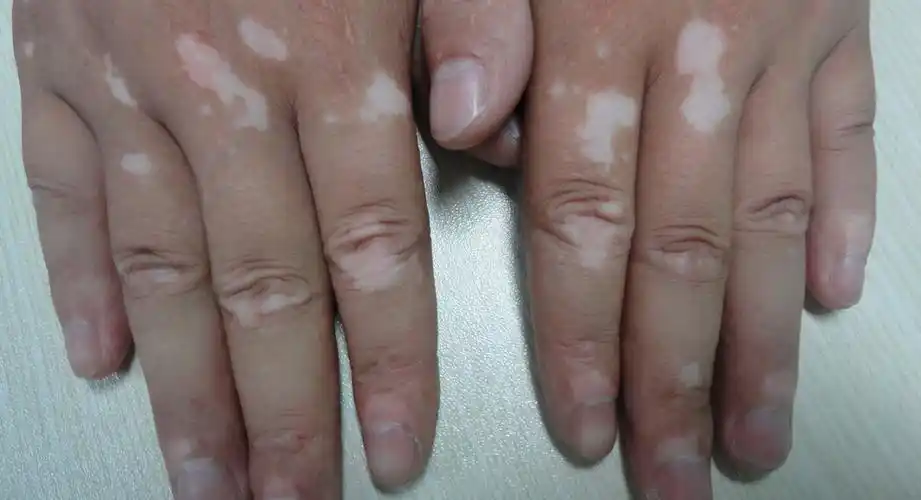 兰州专治白癜风医院