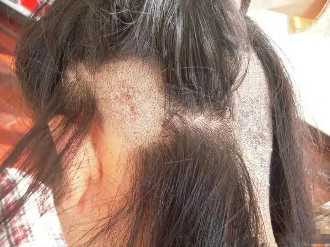 头皮癣早期症状图片5