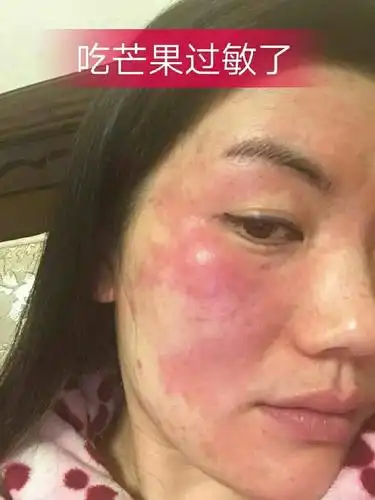 吃芒果过敏了?,还好我有法宝?