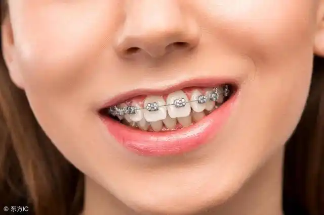 大龅牙做牙齿矫正是传统矫正好还是隐形矫正好