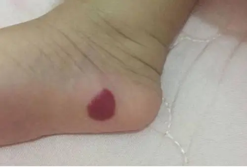 宝妈以为新生宝宝身上的是朱砂痣被网友着急评论赶紧送医院