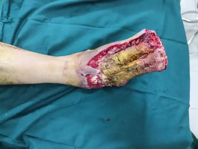 一例足部碾压伤的后期保肢治疗