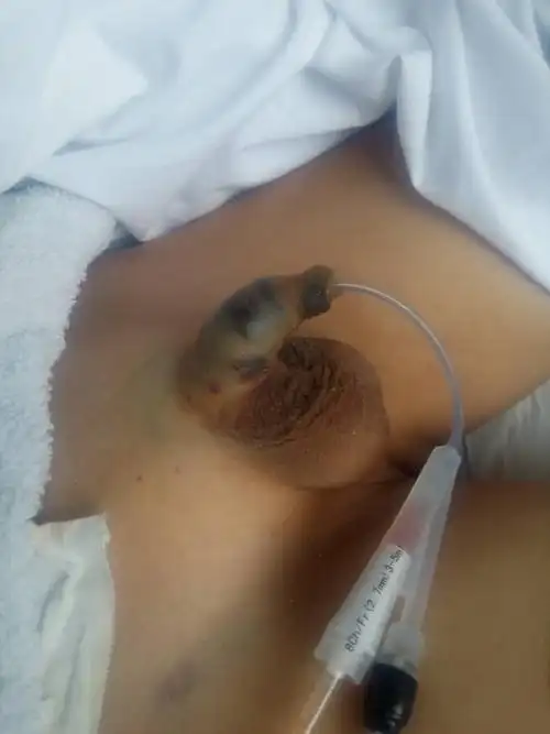 穿刺冲洗后一天