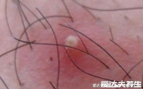 皮肤病图片比较年夜全检查图片包括100种疾病