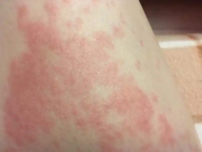 腿上发了大片一大片的痒的东西红的很痒