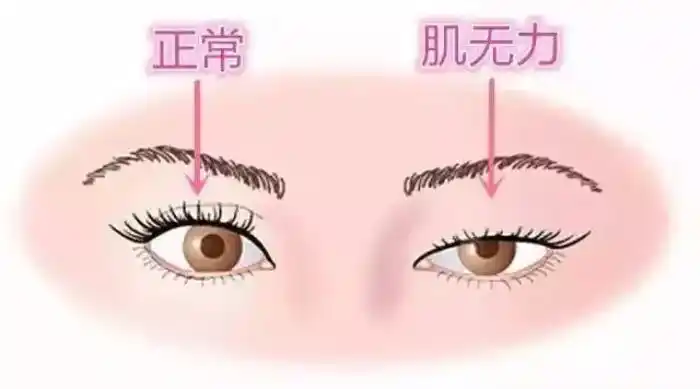 知识点:提肌无力.